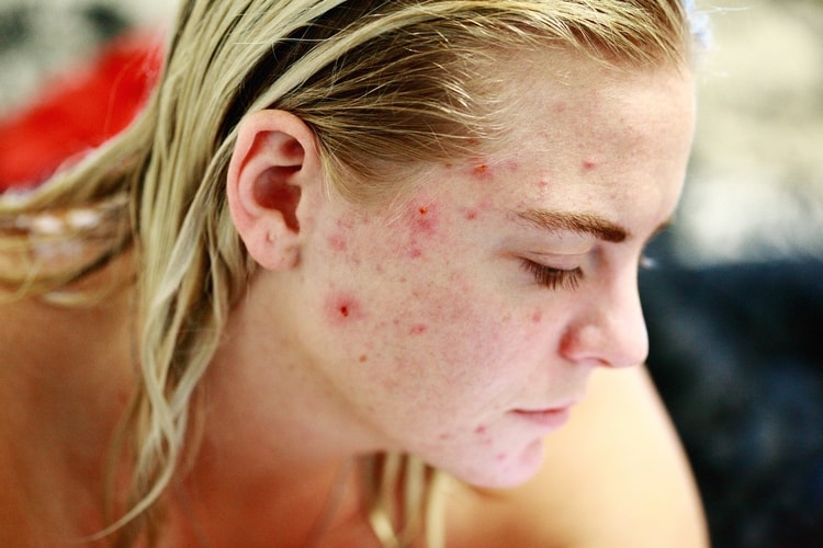 acne on woman's face