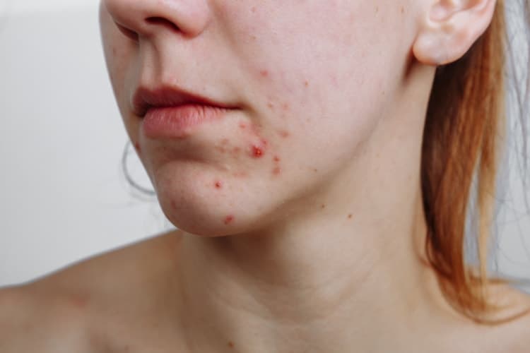 factors that trigger hormonal pimples