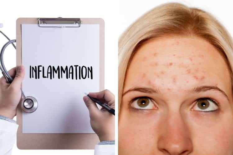 does inflammation in the body cause acne