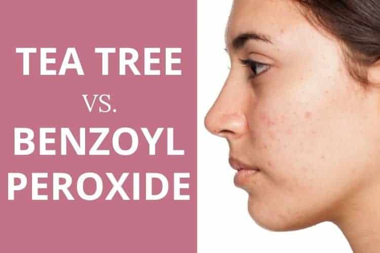Tea tree oil vs benzoyl peroxide for acne