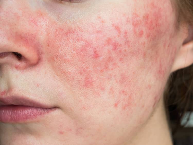 closeup of woman with rosacea