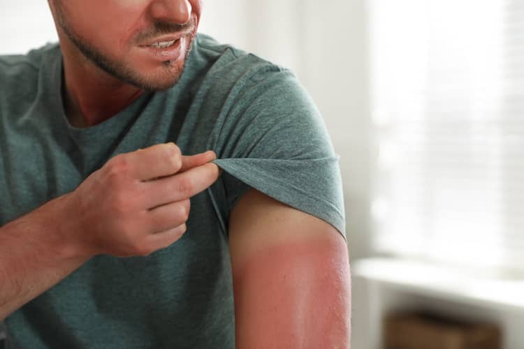 man with burn sunburnt arm
