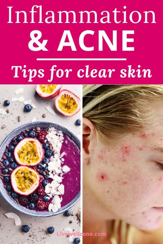 pin for does inflammation in the body cause acne